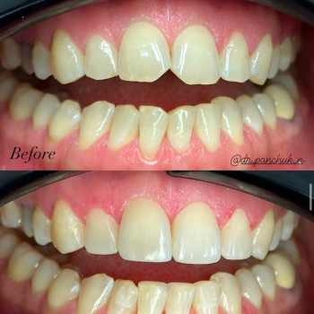 Художня реставрація 6 зубів