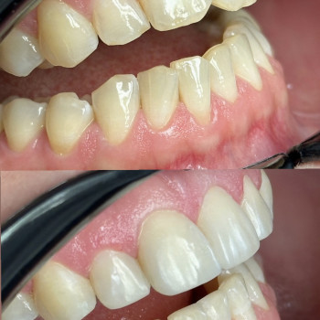 Художня реставрація 6 зубів