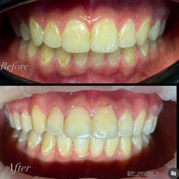 Лікування карієсу системою Icon