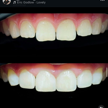 Художня реставрація 4 зубів