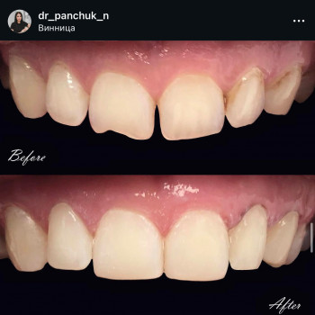 Художня реставрація 6 зубів