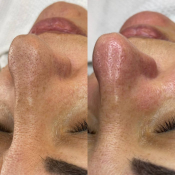 Чистка обличчя