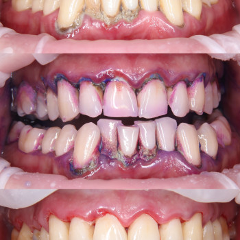 Пародонтальна гігієна