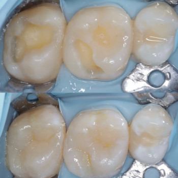 Лікування карієсу та заміна старої реставрації