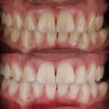 Клінічне відбілювання зубів системою Beyond