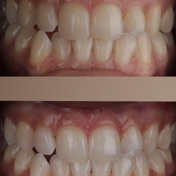 Відбілювання зубів американською системою Beyond
  