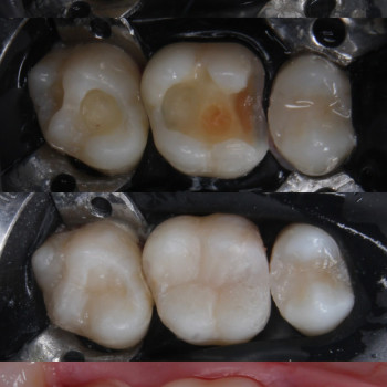 Заміна старих реставрація - відновлення функції та естетики зубів
  