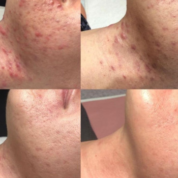 Лікування акне