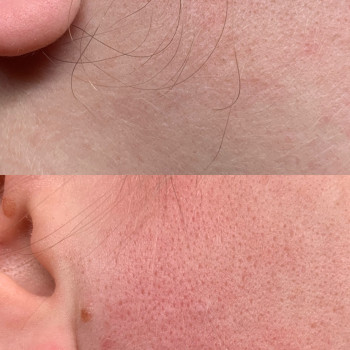 Електроепіляція
                    Электролог Нина Киев