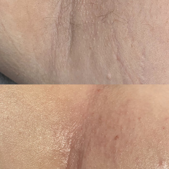 Електроепіляція
                    Электролог Нина Киев