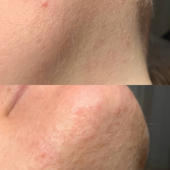 Електроепіляція
                    Электролог Нина Киев