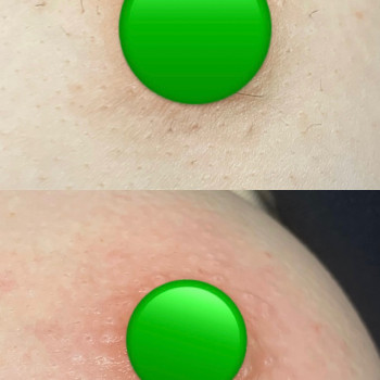 Електроепіляція
                    Электролог Нина Киев