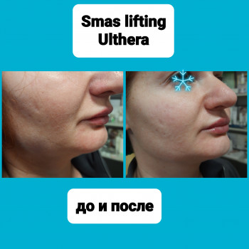Смас лифтинг нижней трети на оригинальной Ulthera
 