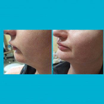 Корекція другого підборіддя(до и 30хвилин після
 
 