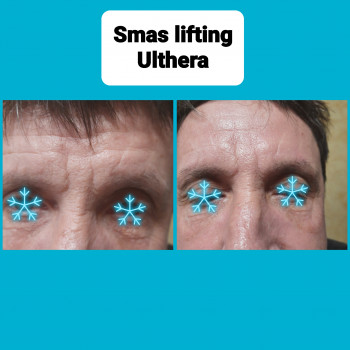  
 
До и после Smas Ulthera