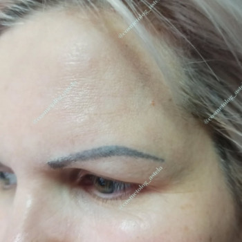 Ін'єкції ботокса в лоб (усунення зморшок на лобі)
                    Косметолог Анна Винница