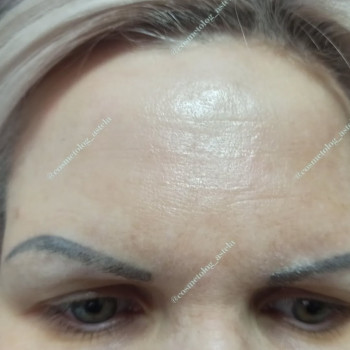 Ін'єкції ботокса в лоб (усунення зморшок на лобі)
                    Косметолог Анна Винница