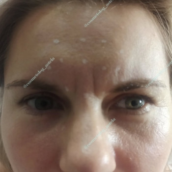 Ін'єкції ботокса у міжбров'я (усунення вертикальних та горизонтальних зморшок)
                    Косметолог Анна Винница
