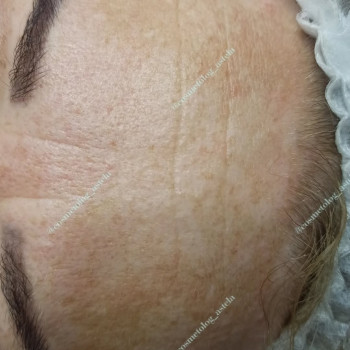 Мезотерапія обличчя (від пігментних плям)
                    Косметолог Анна Вінниця