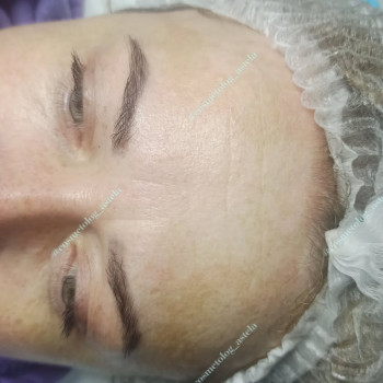 Мезотерапія обличчя (від пігментних плям)
                    Косметолог Анна Вінниця