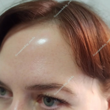 Ботулінотерапія (BOTOX)
                    Косметолог Анна Винница