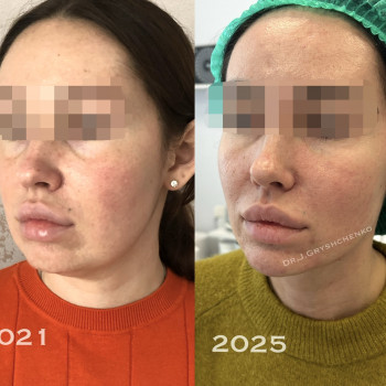 Полегшення нижньої третини обличчя 
Ліфтинг 
Антибриля 
Контурна пластика