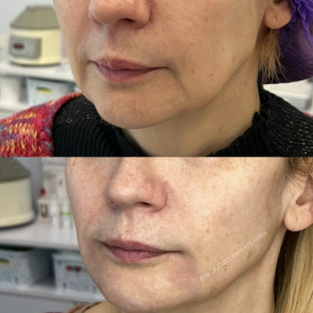 Омолодила овал 
Ліфтинг