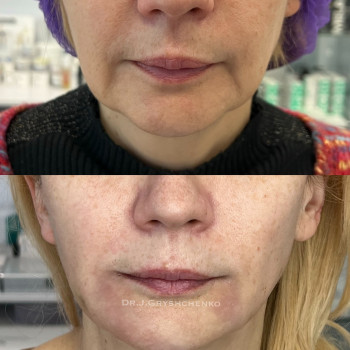 Омолодила овал 
Ліфтинг