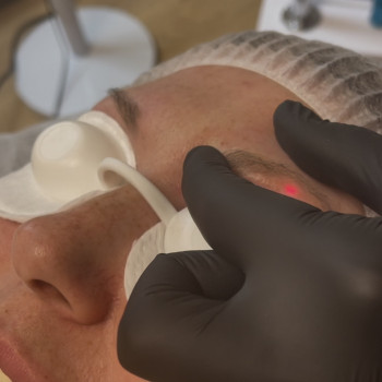 Лазерне видалення татуажу ефективно та безпечно виводить пігмент без пошкодження шкіри, мінімізуючи...