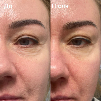 Лімфодренажний масаж обличчя

1 сеанс