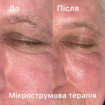 Мікрострумова терапія

1 сеанс