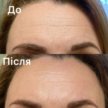 Міофасціальний масаж обличчя

1 сеанс