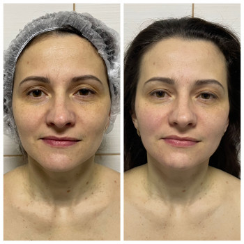 Міоліфтинговий масаж обличчя. Результат однієї процедури