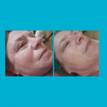  
До и после первой процедуры