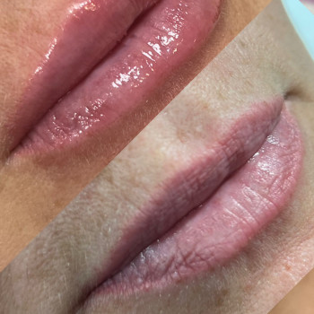 Аугментація збільшення губ