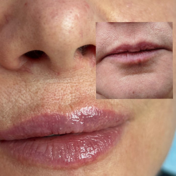 Кореція вікових губ . Надання їм форми і легкого обʼєму