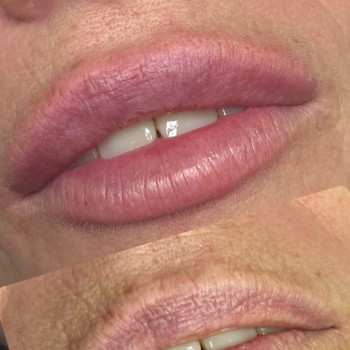 Корекція форми губ , зволоження , надання обʼєму