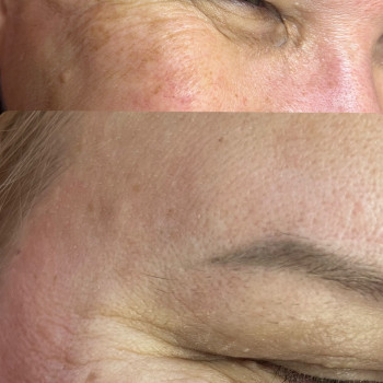 Ботулінотерапія зона навколо очей