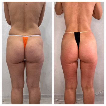 Антицелюлітний масаж
                    Масажист Елена Одеса