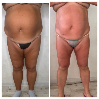 Lipokiller
                    Массажист Елена Одесса