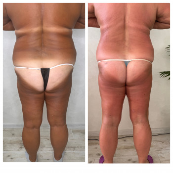 Lipokiller
                    Массажист Елена Одесса