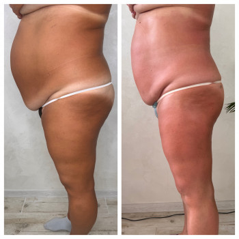 Lipokiller
                    Массажист Елена Одесса