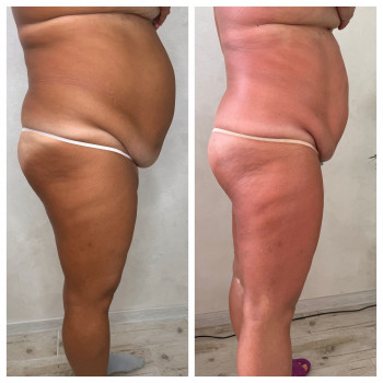 Lipokiller
                    Массажист Елена Одесса