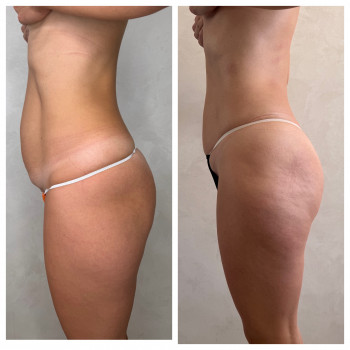 Lipokiller
                    Массажист Елена Одесса