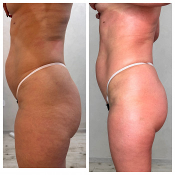 Lipokiller
                    Массажист Елена Одесса