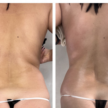 Lipokiller
                    Массажист Елена Одесса