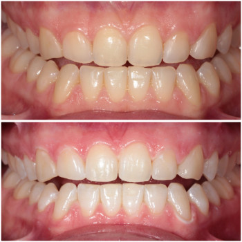 Процедура Beyond – сучасне рішення для білих зубів.