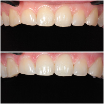 ідбілювання Beyond – ефективний метод естетичної стоматології.