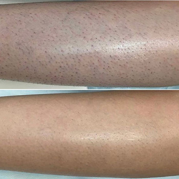 Результат 4 сеансів лазерної епіляції