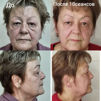  #Векторный_массаж_лица
 #Векторний_масаж_обличчя
 #скульптурний #лiмфодренажний #вiд_зморшок #мiофасциальний #пластичний